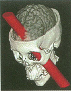 Figure 3-1 Depiction of the rod in Phineas Gage’s brain.