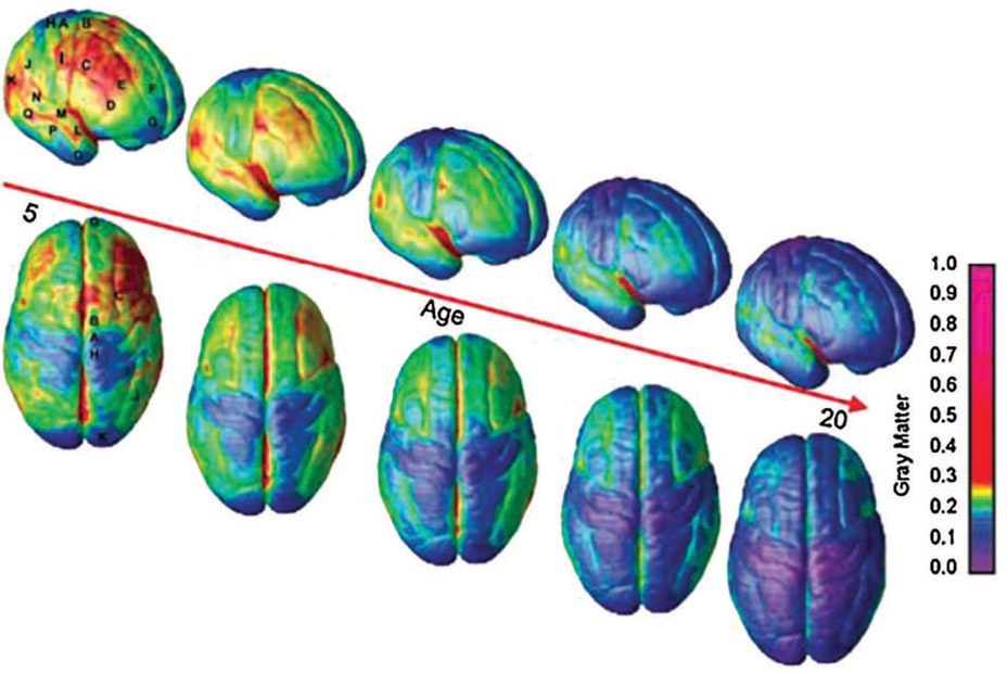 Figure 4-2 Changes in gray matter volume in the brains of those age 5 to age 20. Red color shows the highest gray matter volume and violet the lowest. As a person matures, the brain forms more connections with myelin sheaths (white matter) and thus reduces the gray matter measurements in the brain.