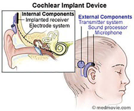 Figure 5-31 With a cochlear implant, external sounds are processed and sent directly to the auditory nerve.