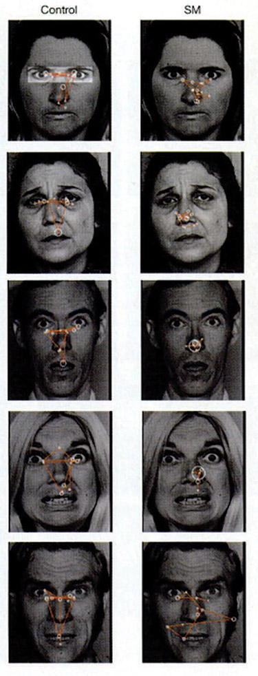 Figure 10-15 The location of where individuals look when viewing emotional faces. SM does not look at the eyes.