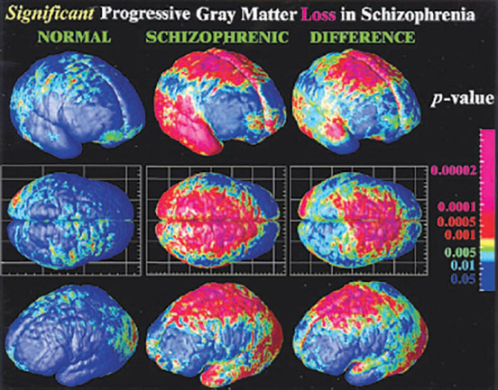 Figure 14-9 Annual loss of gray matter in those with schizophrenia.